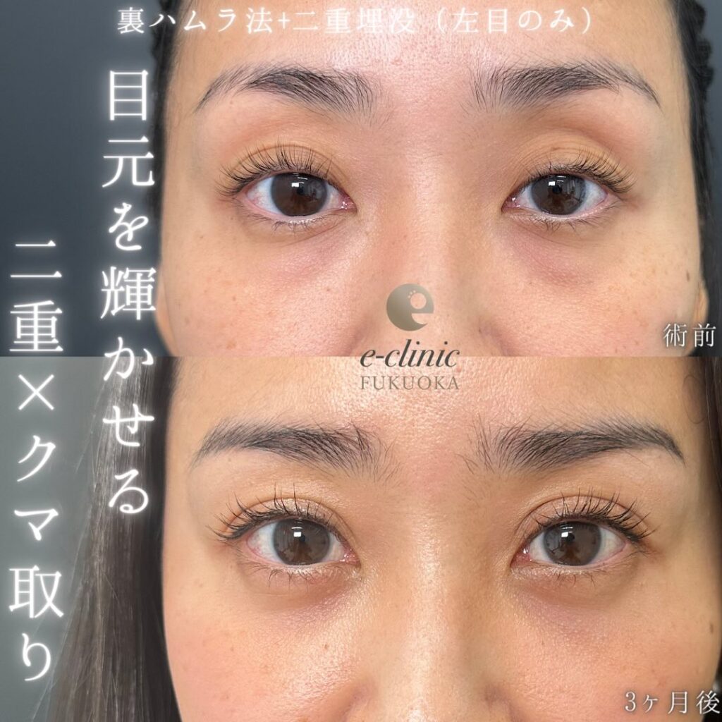 裏ハムラ法と埋没法の症例写真 (1)