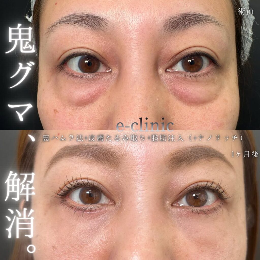 裏ハムラ法と脂肪注入の症例写真 (9)