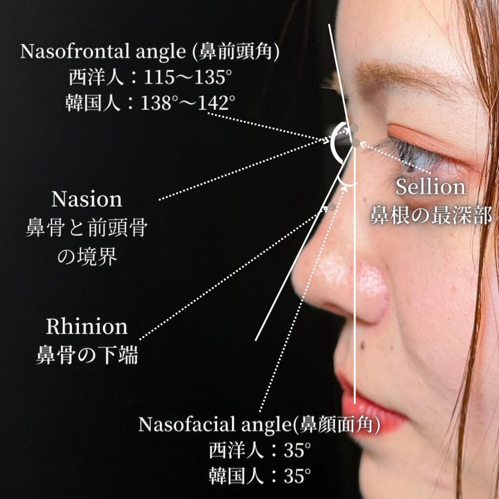 鼻中隔延長と鼻尖形成と軟骨移植とプロテーゼと他院修正の症例写真 (2)