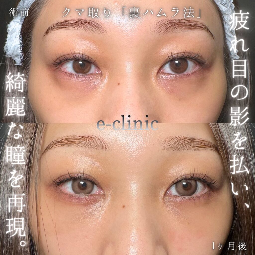 裏ハムラ法と涙袋と目の下のヒアルロン酸の症例写真 (1)