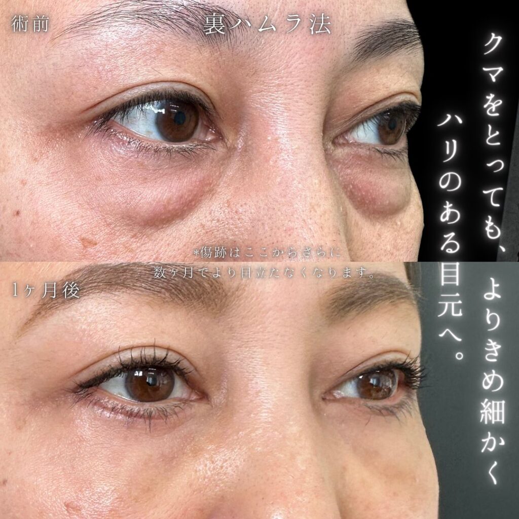 裏ハムラ法と脂肪注入の症例写真 (8)