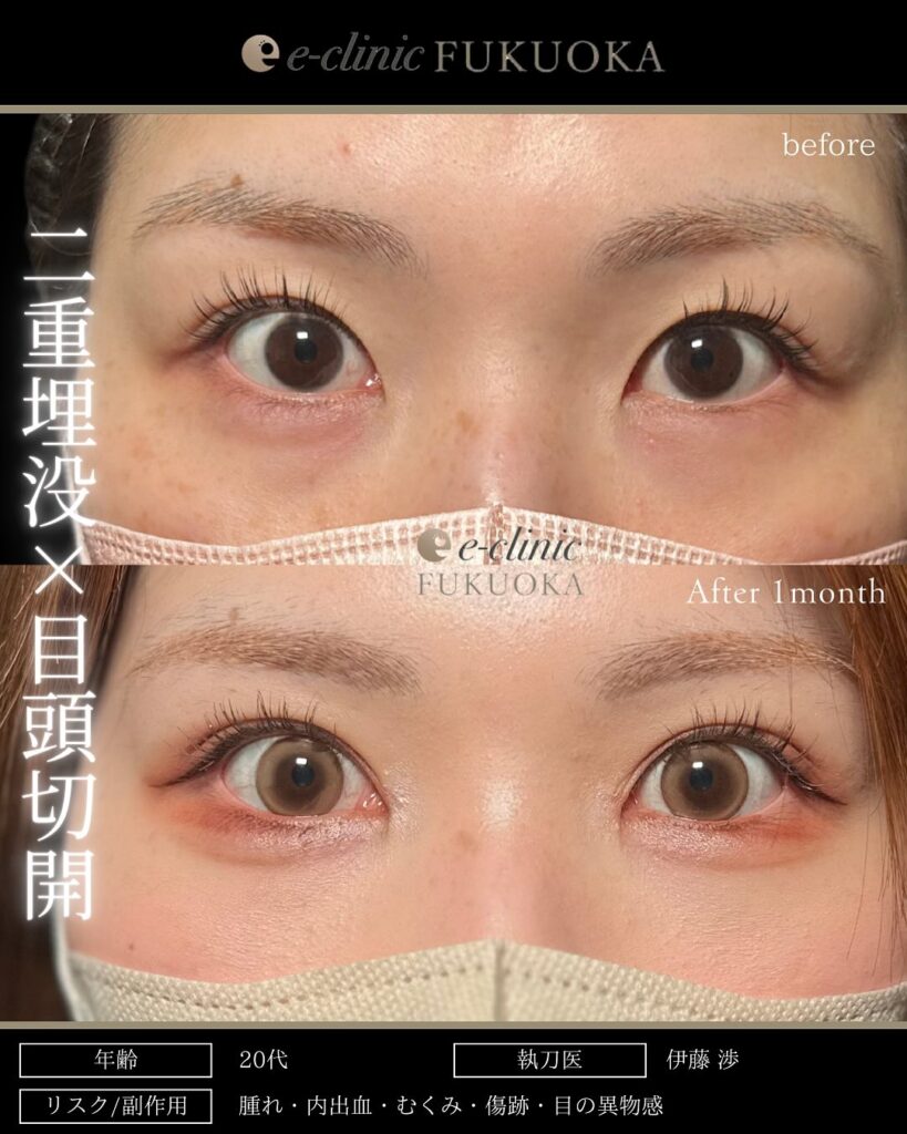 埋没法と目頭切開の症例写真 (1)