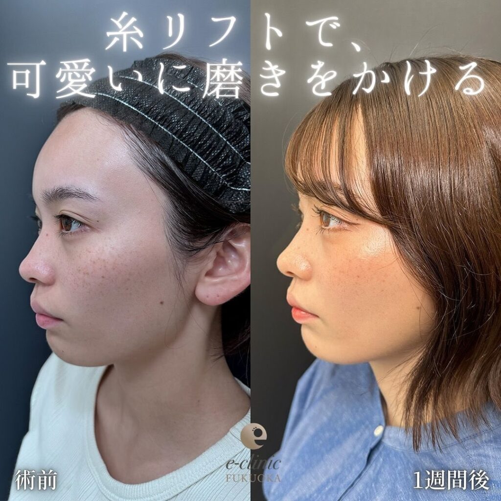 糸リフトの症例写真 (5)