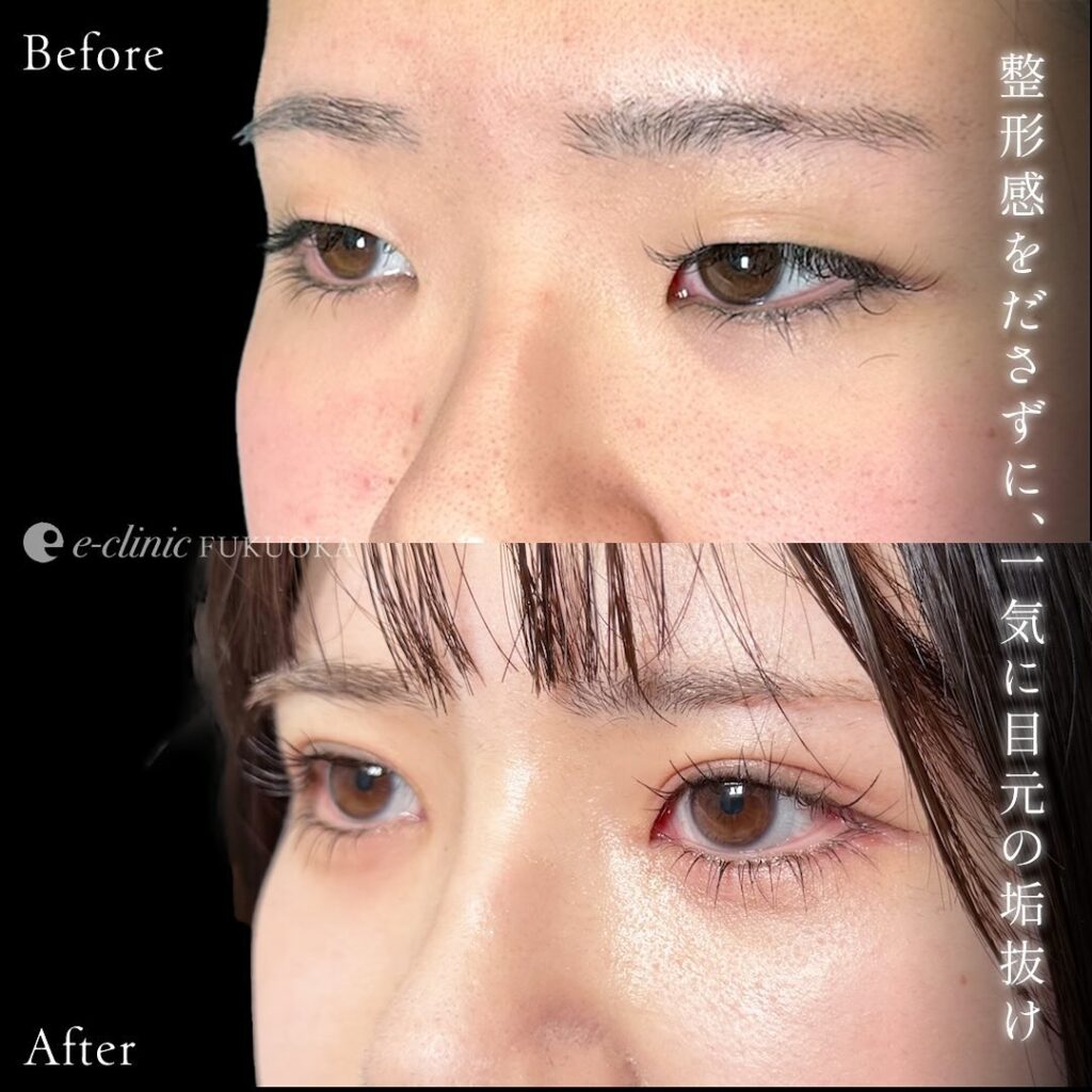 目元拡大の症例写真 (2)