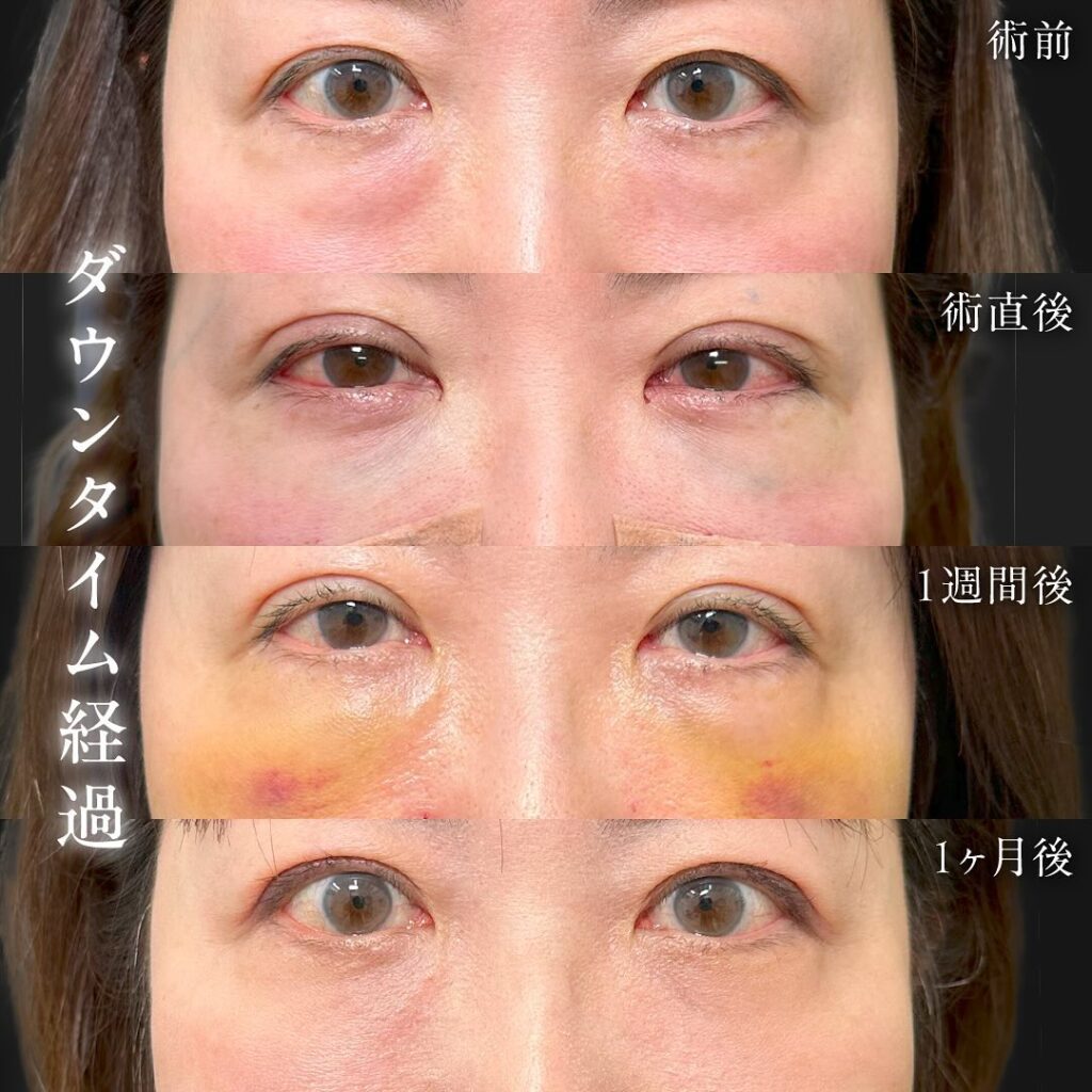 裏ハムラ法と埋没法の症例写真 (9)