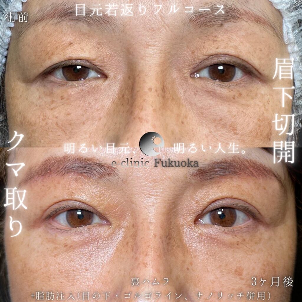 裏ハムラ方と眉下切開と脂肪注入の症例写真 (1)