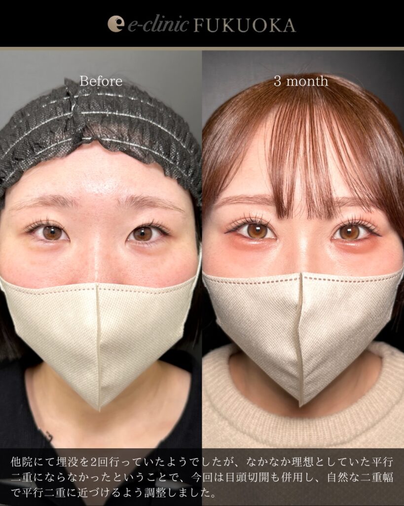 埋没法と目頭切開の症例写真 (15)