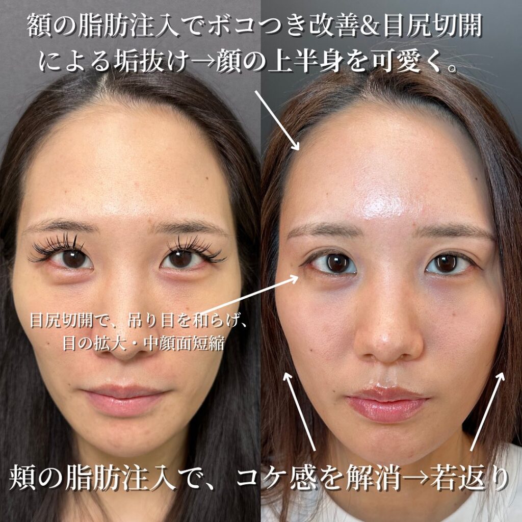 頬と額の脂肪注入と目尻切開の症例写真 (6)