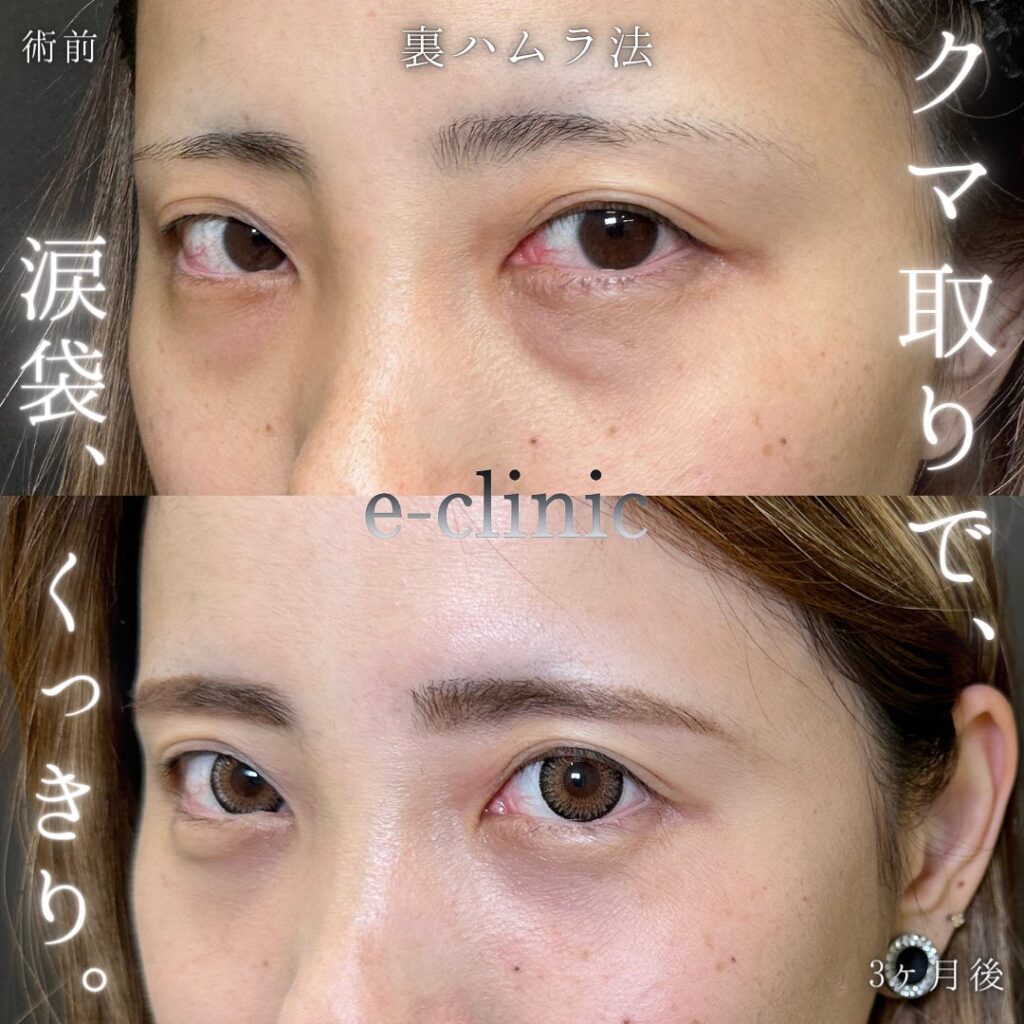 裏ハムラ法の症例写真 (57)