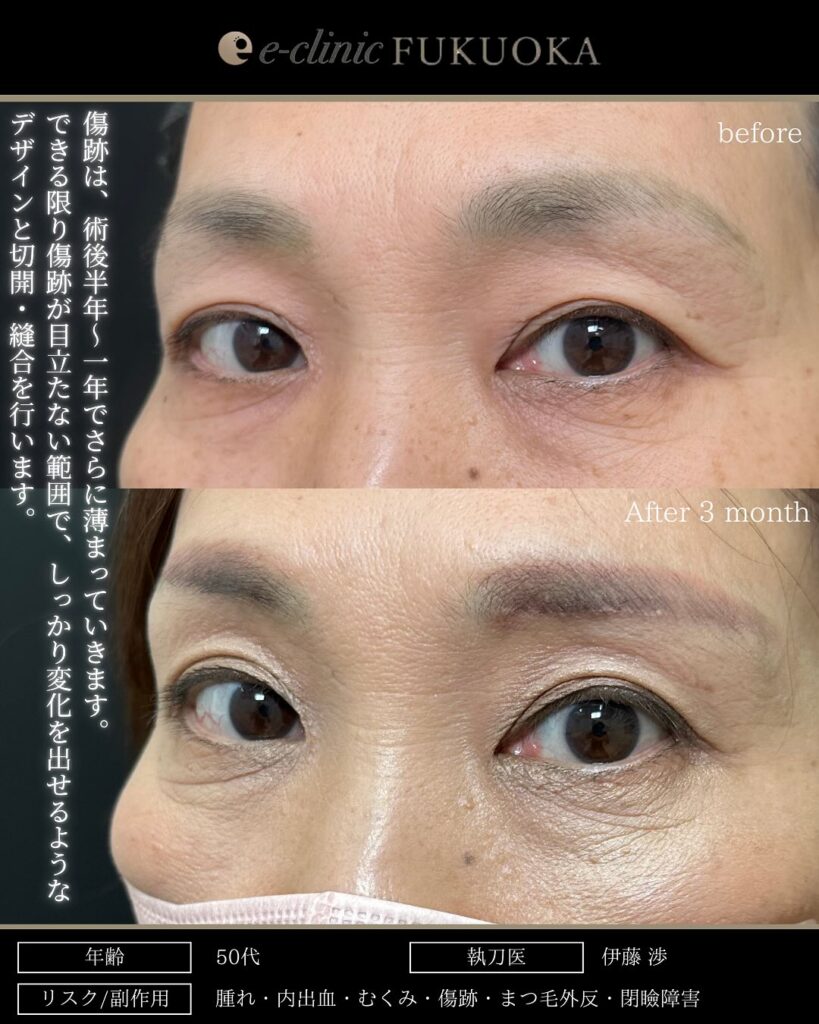 眉下切開の症例写真 (11)