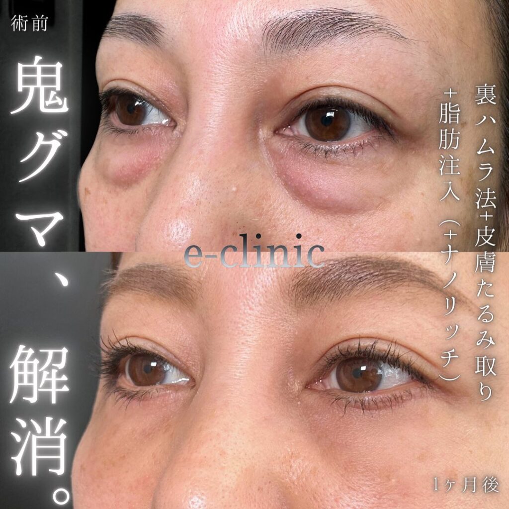 裏ハムラ法と脂肪注入の症例写真 (4)