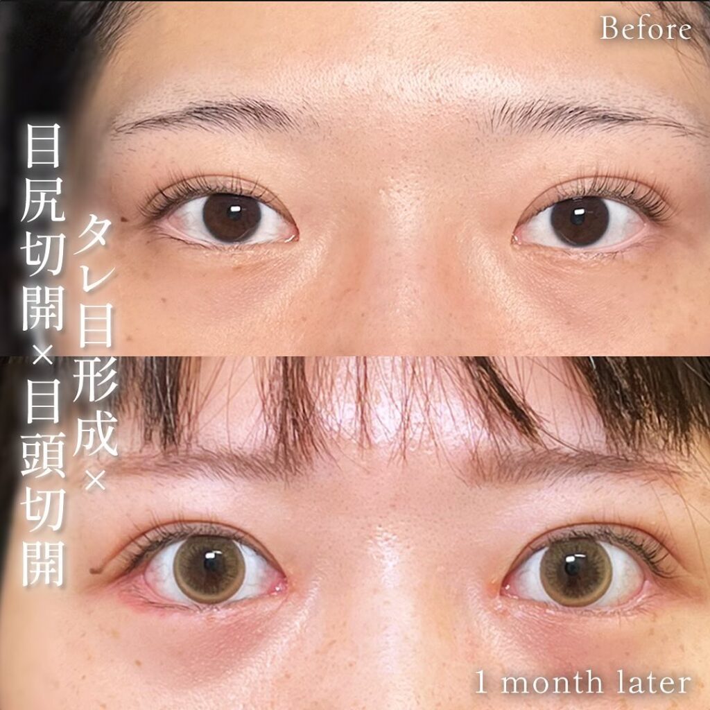タレ目形と目頭切開と目尻切開の症例写真 (1)