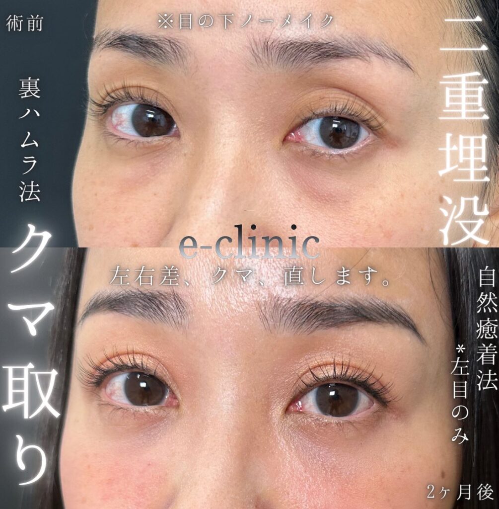 埋没法と裏ハムラ法の症例 (1)