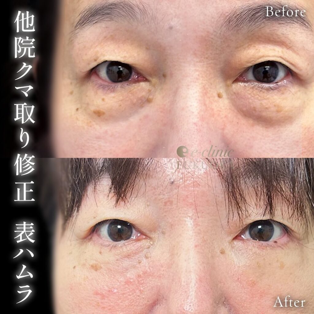 他院修正と表ハムラ法症例写真 (1)