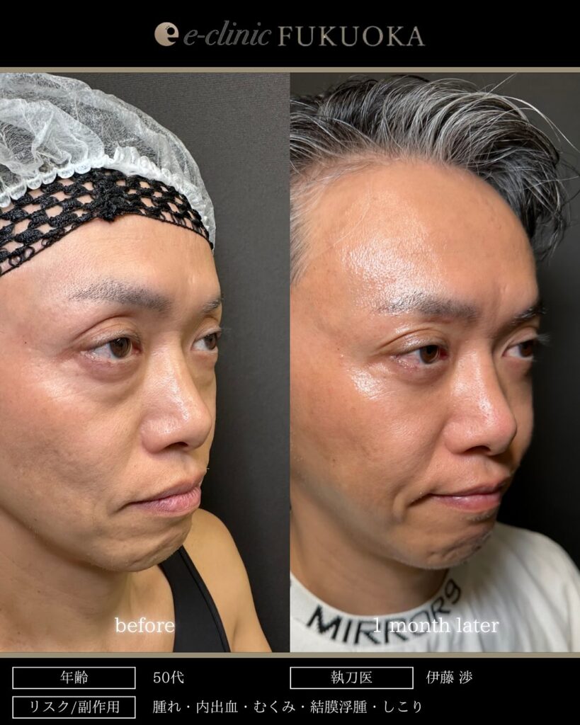 脱脂と脂肪注入の症例写真 (16)