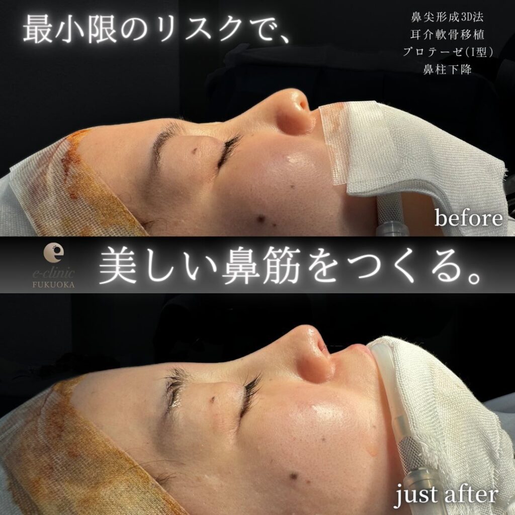 鼻尖形成と軟骨移植とプロテーゼと鼻柱下降の症例写真