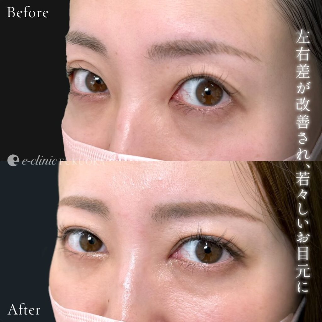 埋没法と他院修正の症例写真 (4)