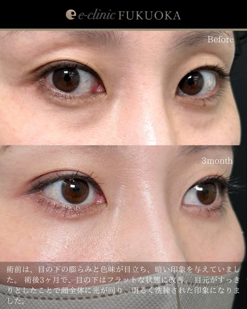 裏ハムラ法の症例写真 (101)