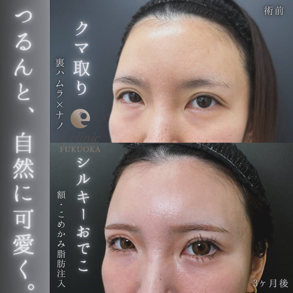 裏ハムラ方と脂肪注入の症例写真 (4)