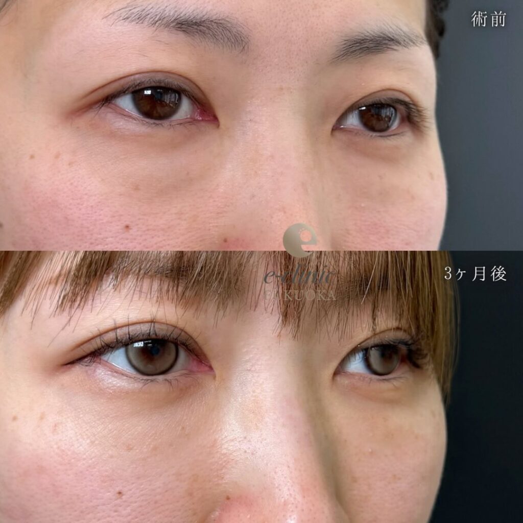 裏ハムラ法の症例写真 (64)