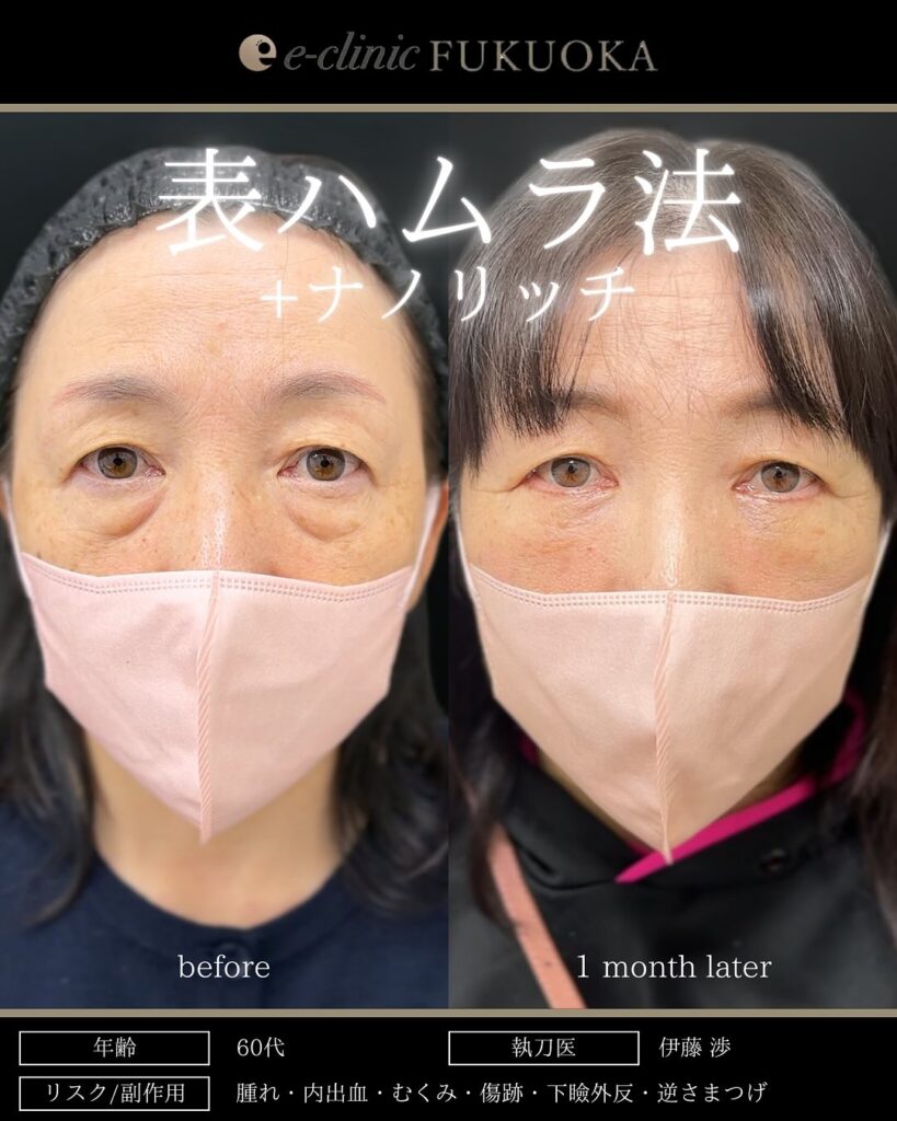 裏ハムラ法と脂肪注入の症例写真 (30)