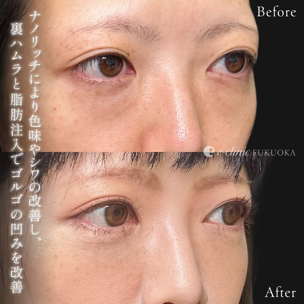 裏ハムラ法と目の下の脂肪注入の症例写真 (9)