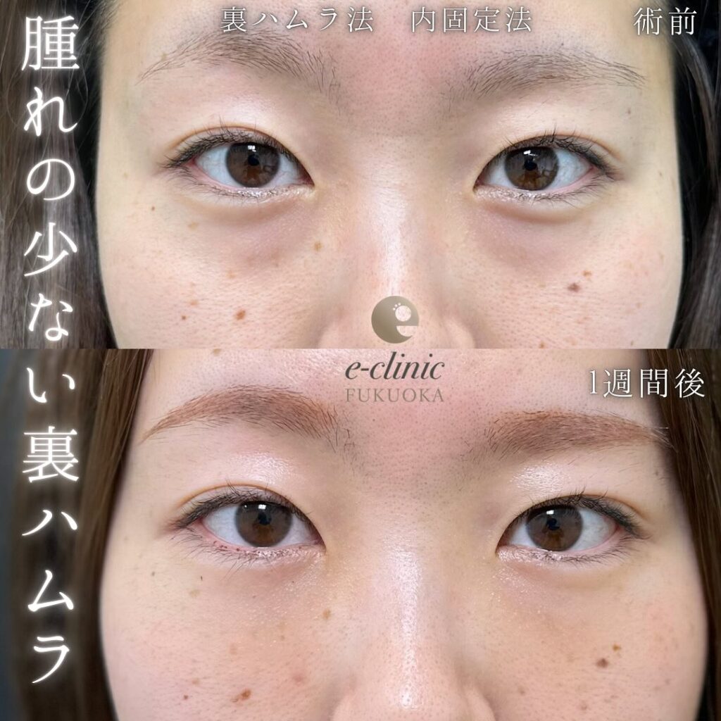 裏ハムラ法の症例写真 (72)