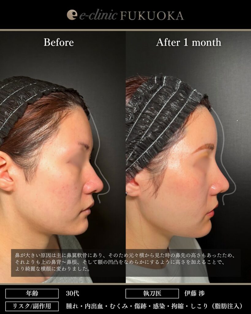 鼻尖形成と軟骨移植と小鼻縮小とプロテーゼと額の脂肪注入と頬の脂肪吸引とジョールファットと糸リフトの症例写真 (4)