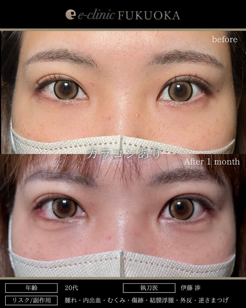 タレ目形成と目尻切開の症例写真 (16)