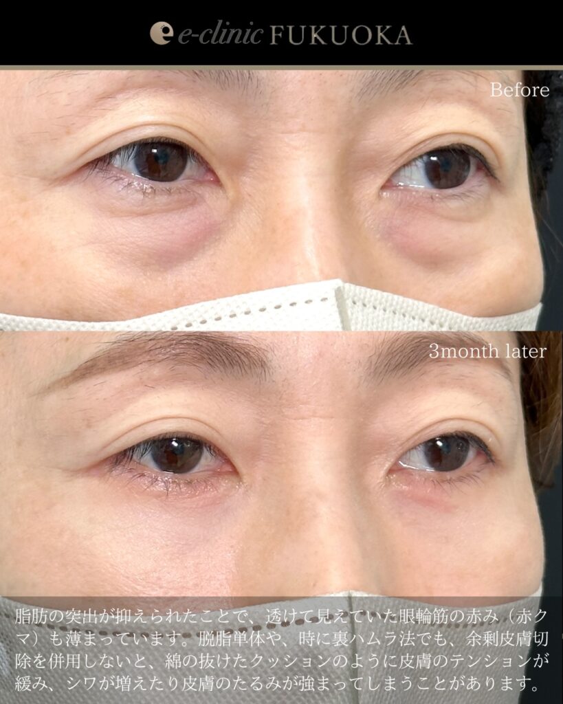 表ハムラ法の症例写真 (7)