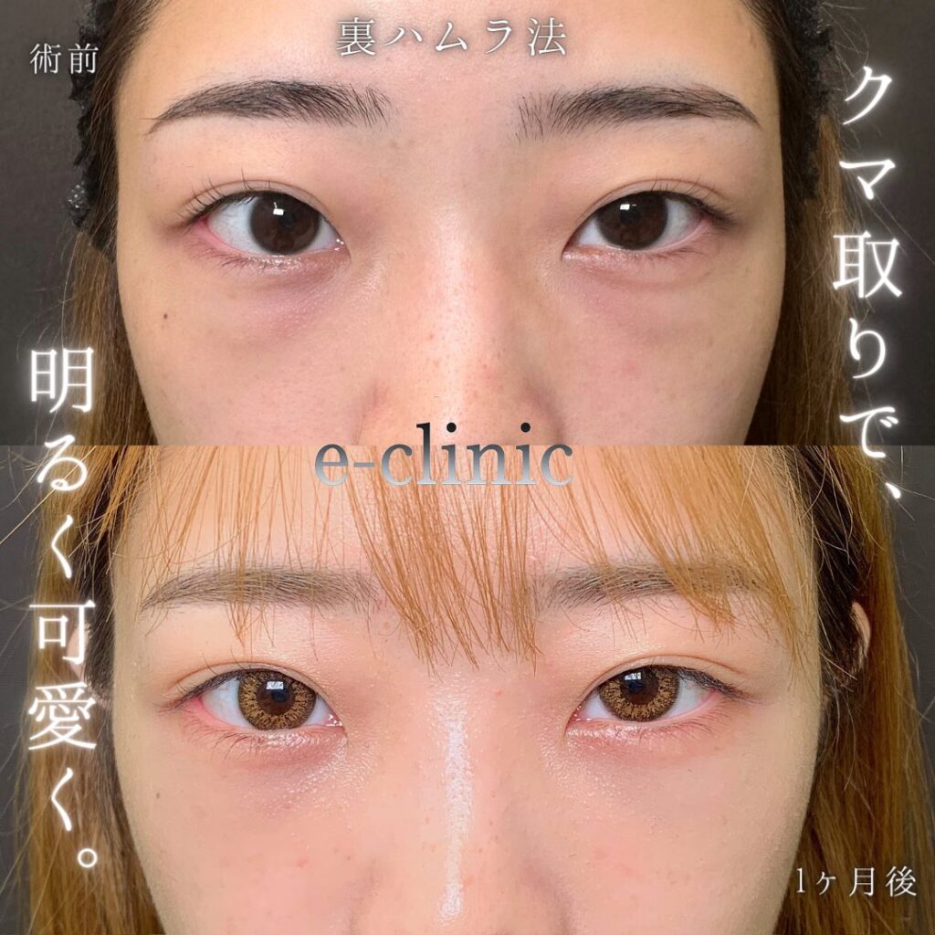 裏ハムラ法の症例写真 (47)