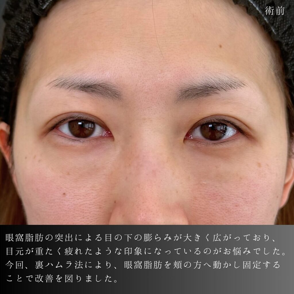 裏ハムラ法の症例写真 (66)