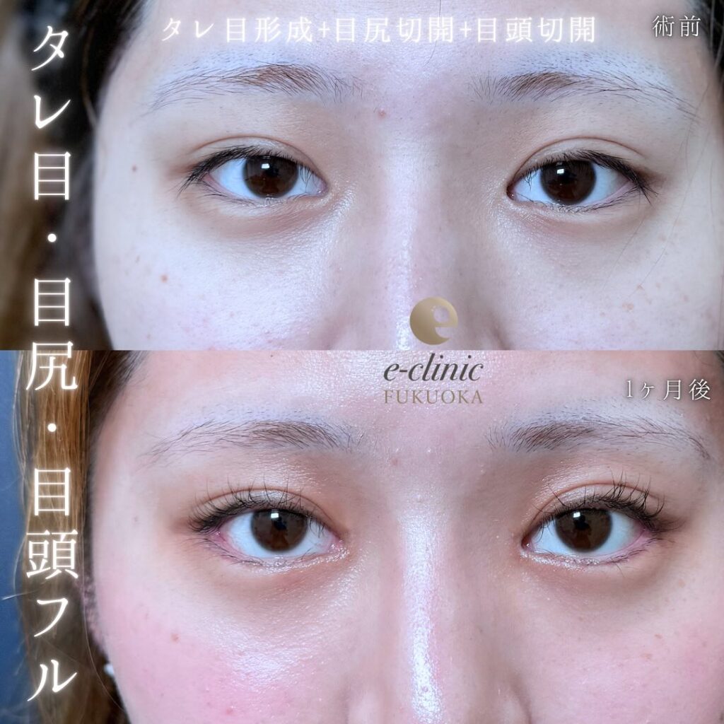タレ目形成と目尻切開と目頭切開の症例写真 (1)