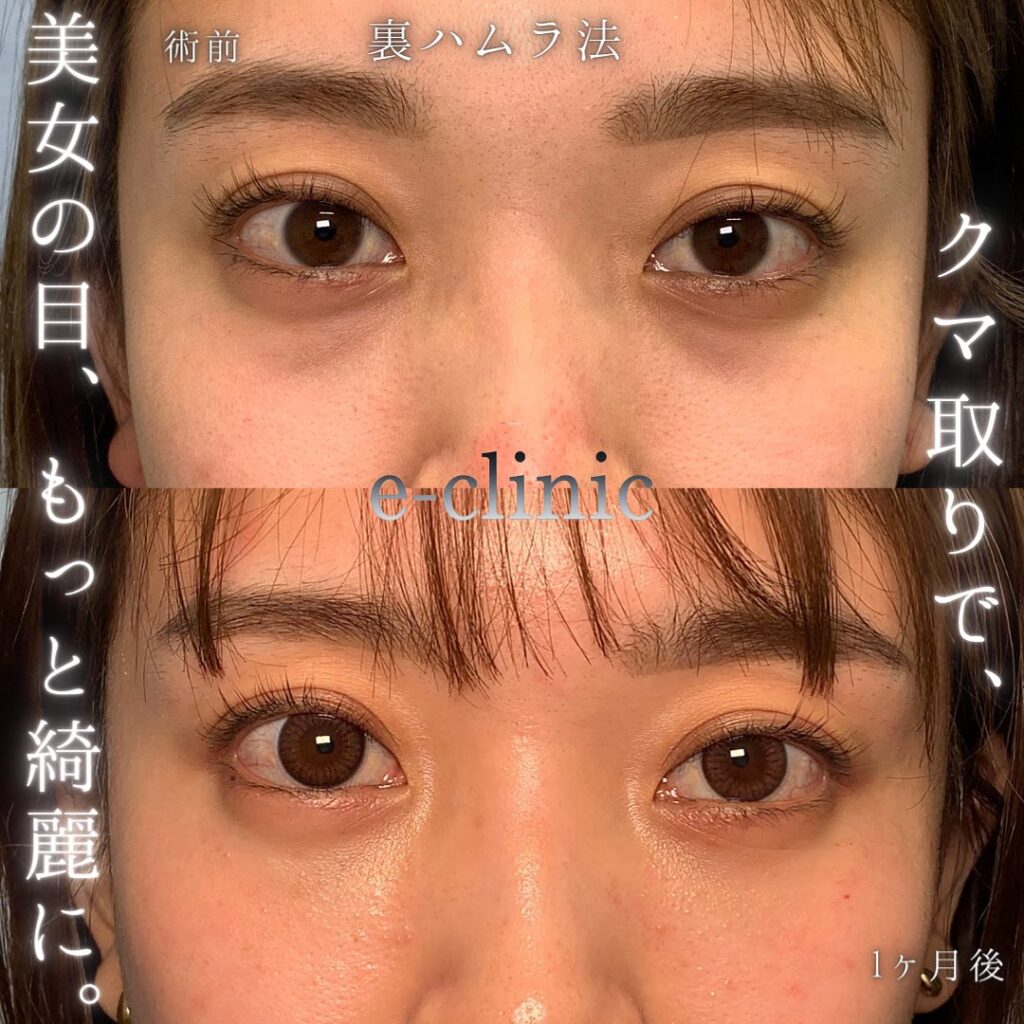 裏ハムラ法の症例写真 (48)