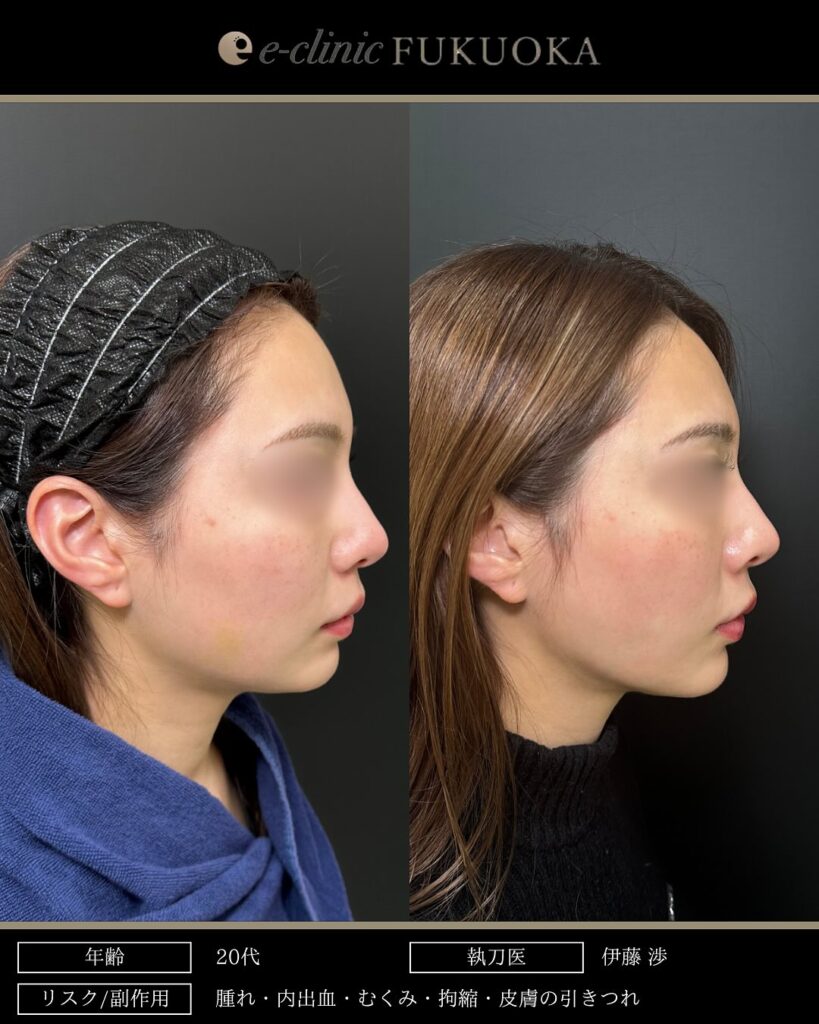 頬と顎下の脂肪吸引とジョールファットとバッカルファットと糸リフトの症例写真 (3)