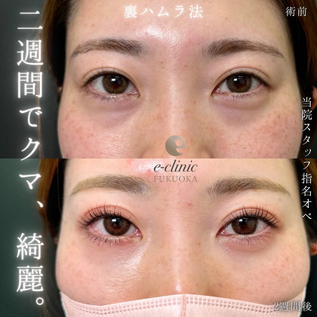 裏ハムラ法の症例写真 (60)