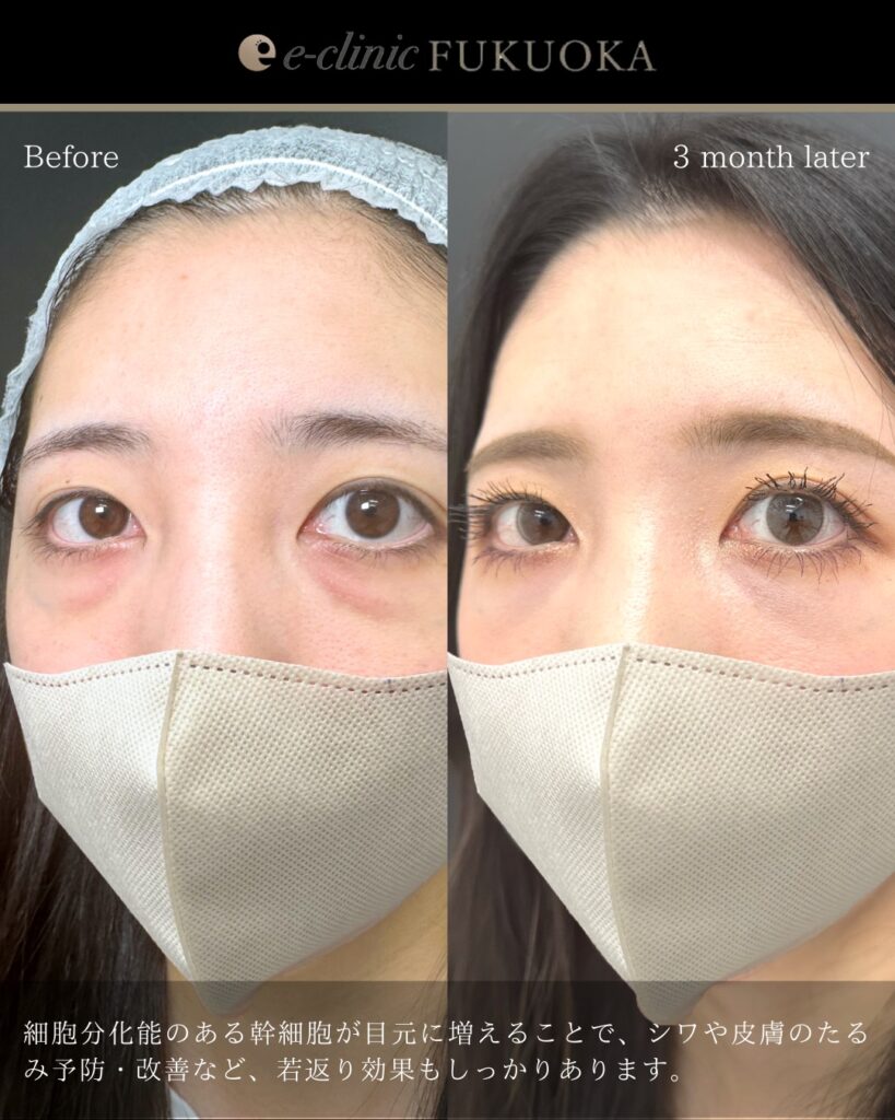 裏ハムラ法とナノリッチの症例写真 (18)