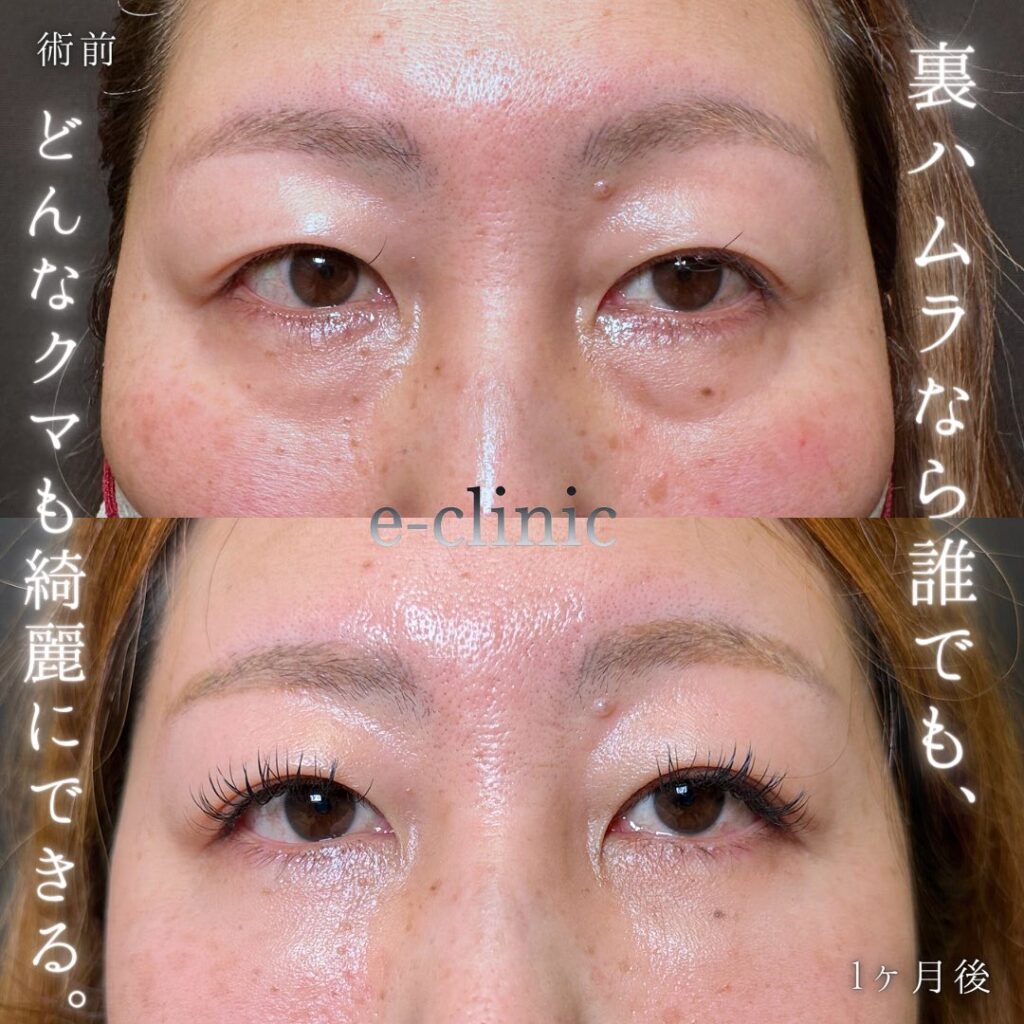 裏ハムラ法の症例写真 (20)