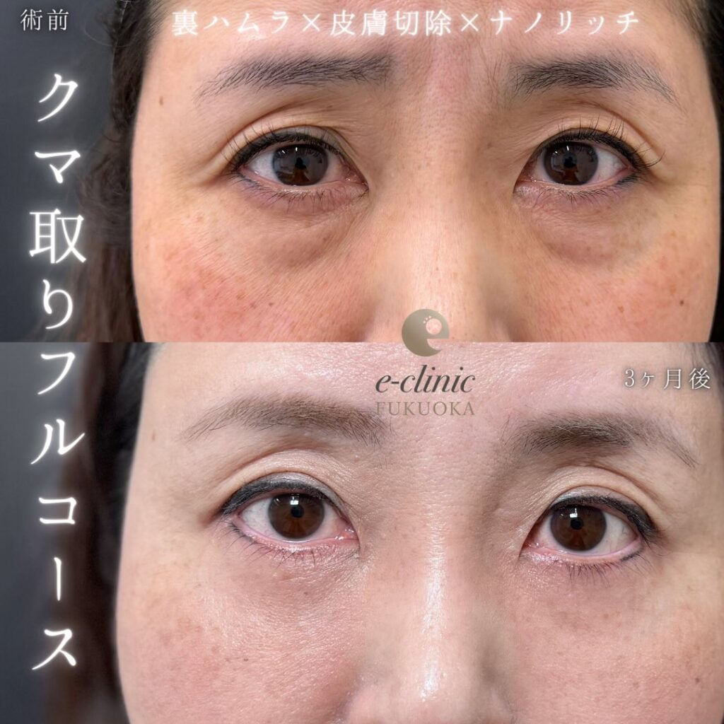 裏ハムラ法と目の下の脂肪注入と額とこめかみの脂肪注入の症例写真 (1)