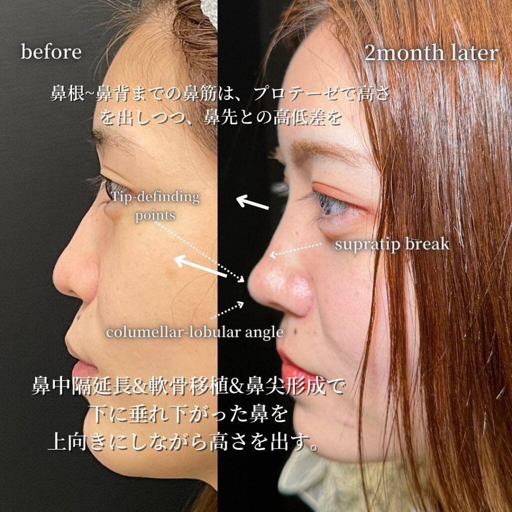 鼻中隔延長と鼻尖形成と耳介軟骨移植とプロテーゼと他院修正の症例写真 (10)