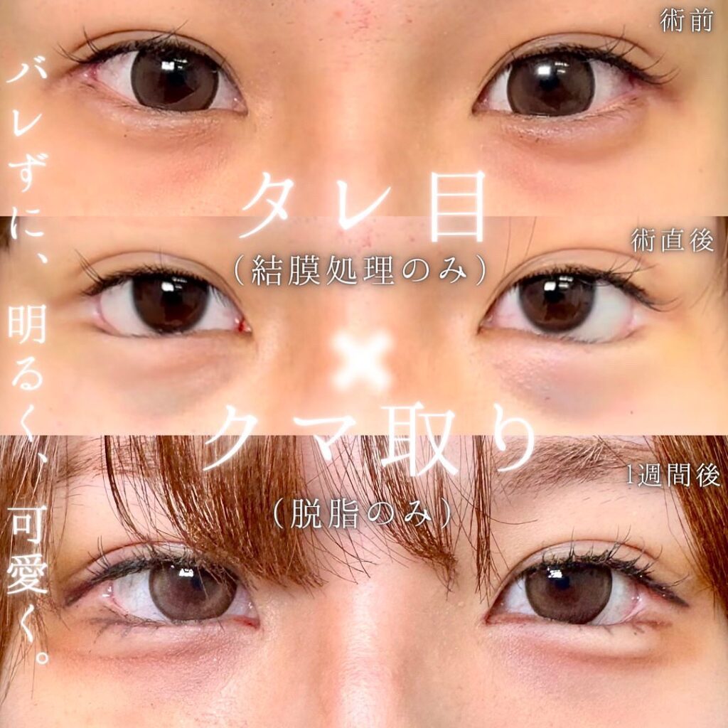 脱脂とタレ目形成の症例写真 (2)