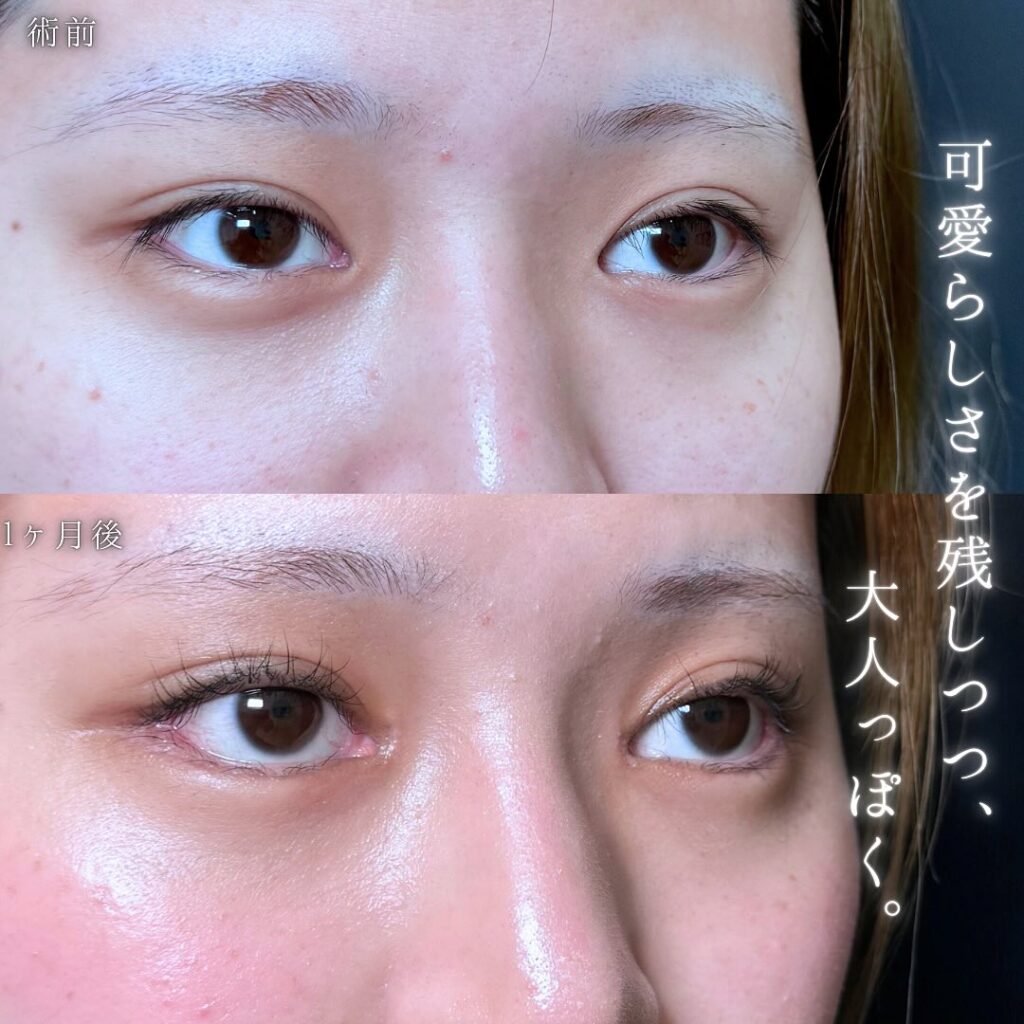 タレ目形成と目尻切開と目頭切開の症例写真 (3)