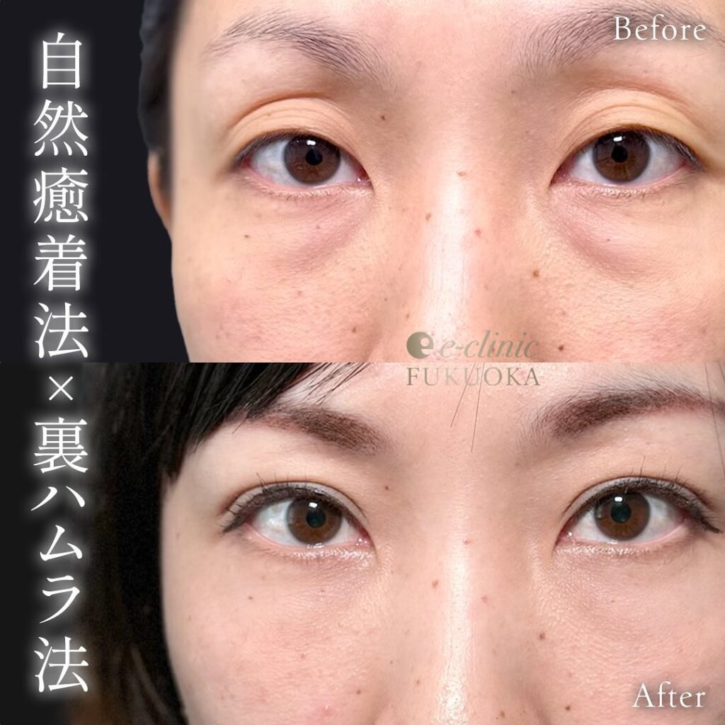 裏ハムラ法と自然癒着法の症例写真 (1)