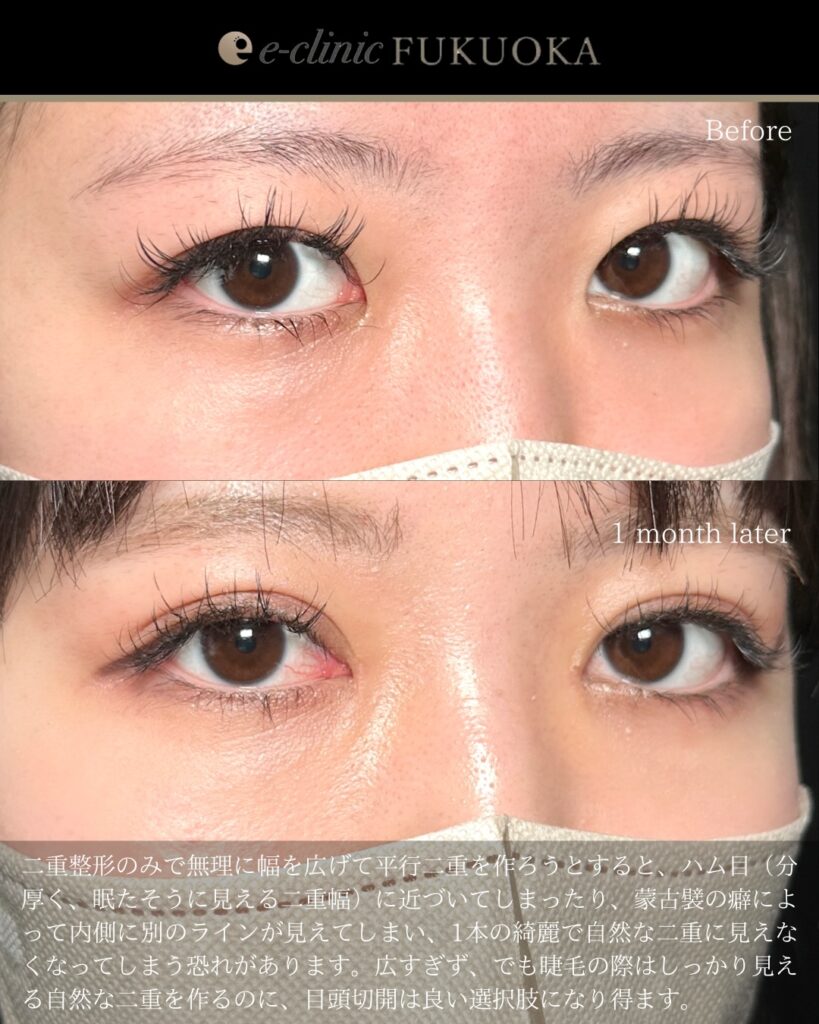 自然癒着法と目頭切開の症例写真 (5)