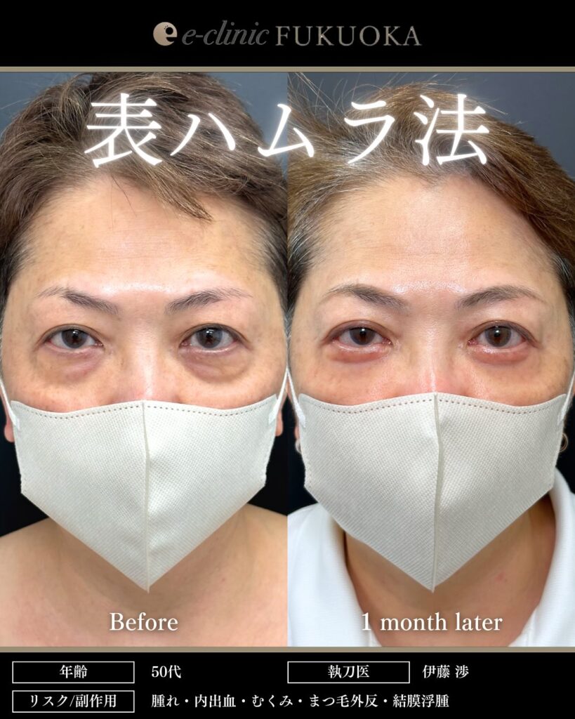 裏ハムラ法とナノリッチとボトックスの症例写真 (1)