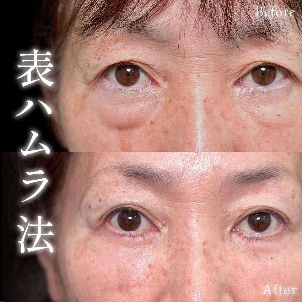 表ハムラ法の症例写真 (1)