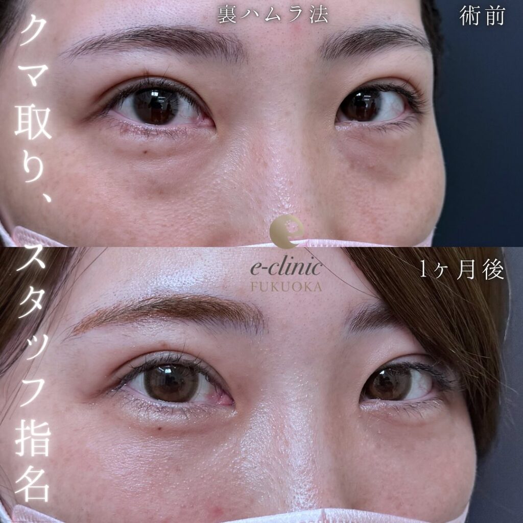 裏ハムラ法の症例写真 (77)