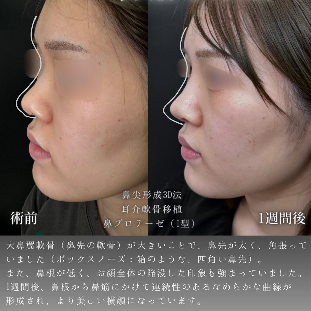 鼻尖形成と耳介軟骨移植とプロテーゼの症例写真 (1)