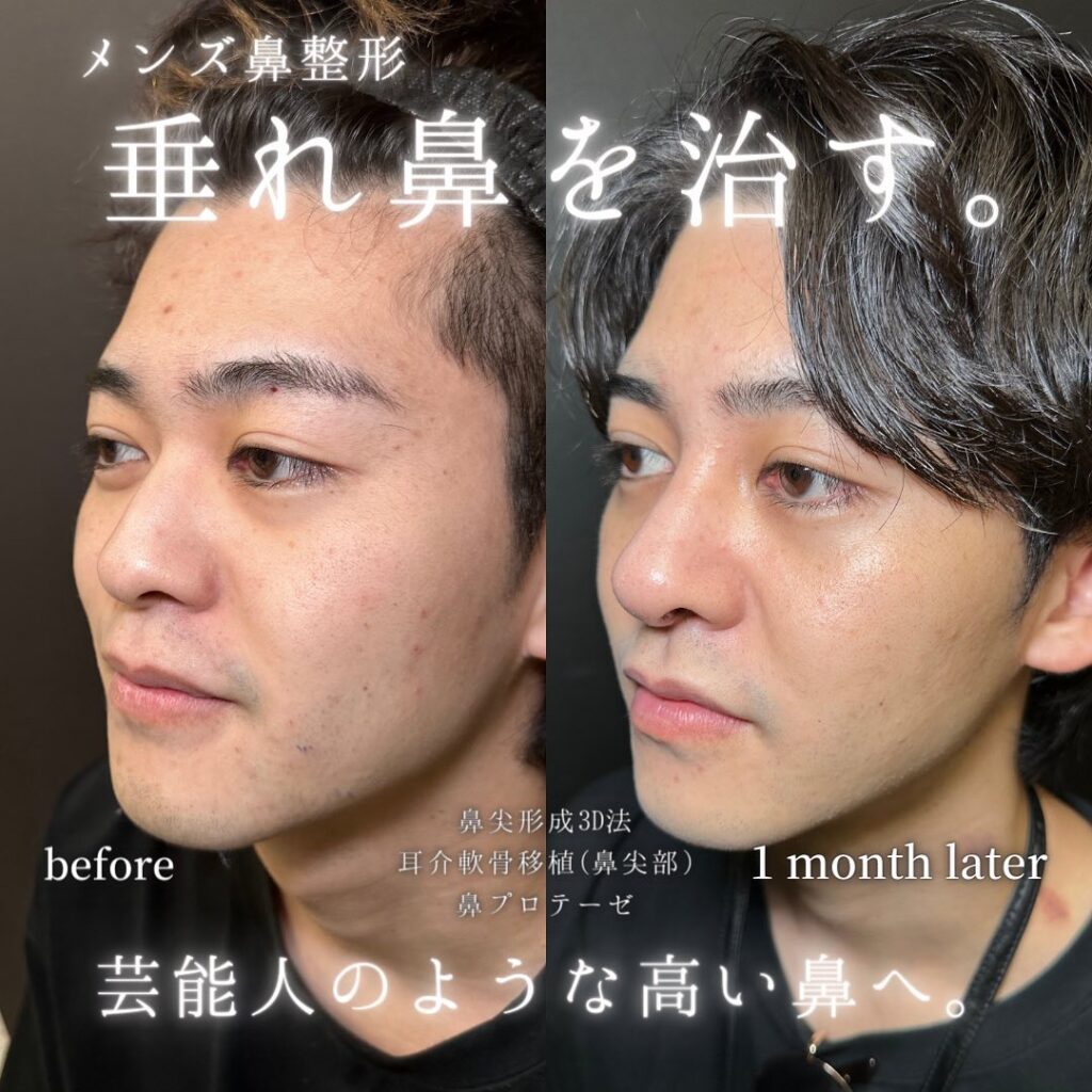 鼻尖形成と軟骨移植とプロテーゼの症例写真 (1)