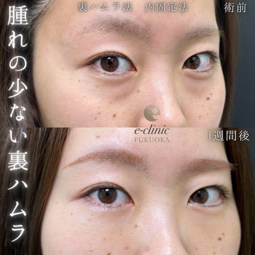 裏ハムラ法の症例写真 (74)